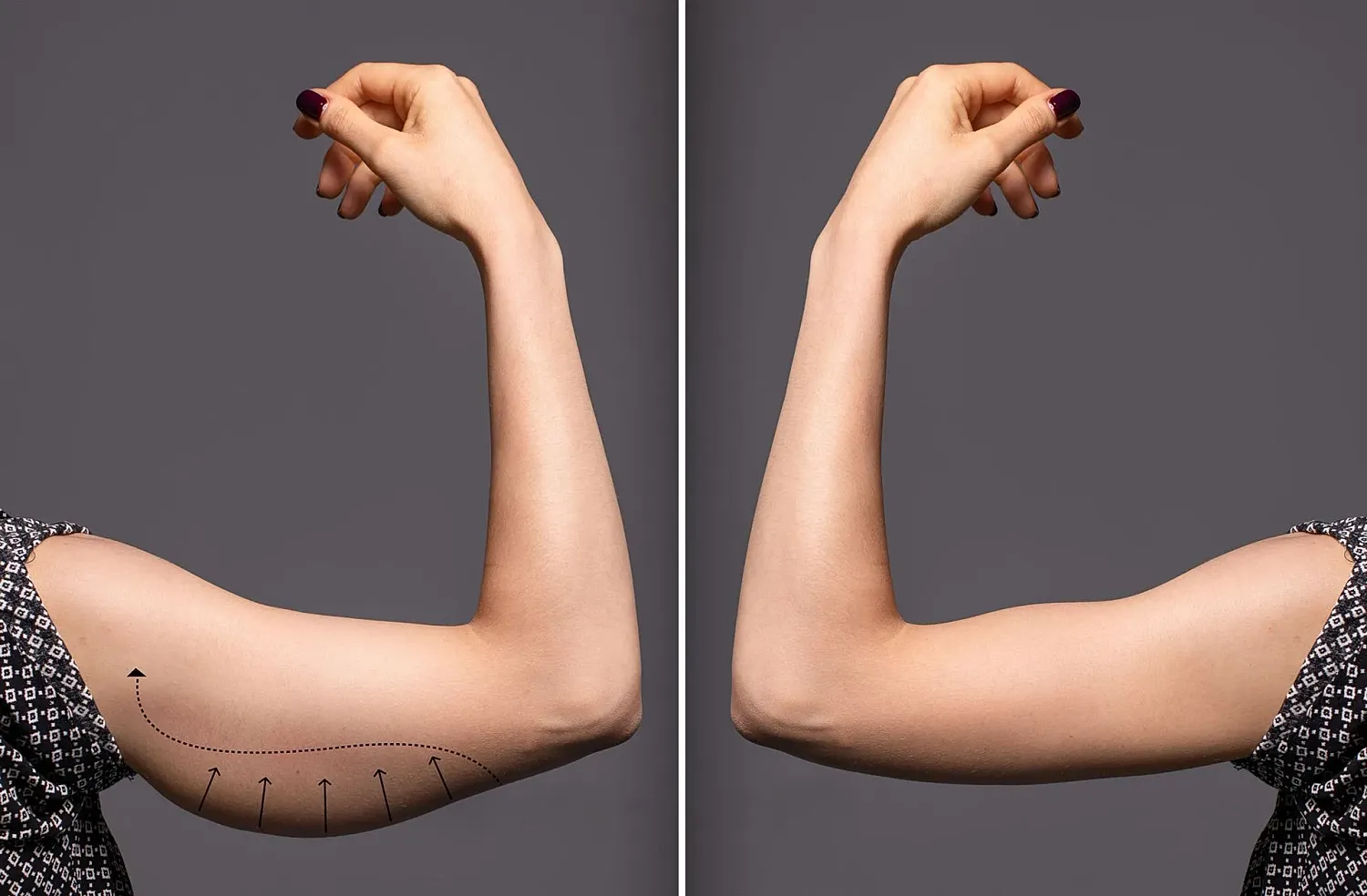 Comparison of two flexed arms showing muscle definition.