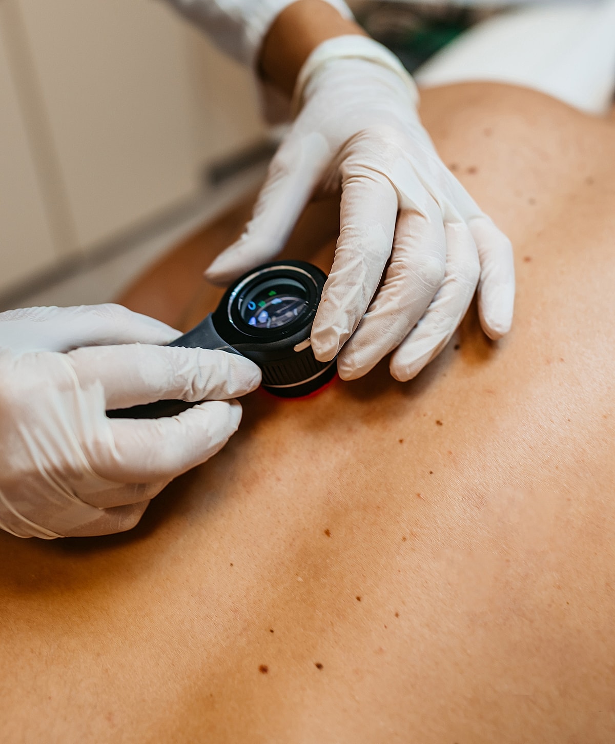 Dermatologist examining skin with handheld device.