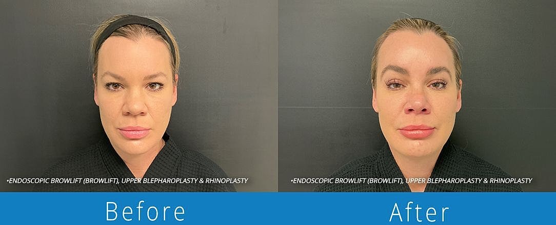 Brow Lift Before & After