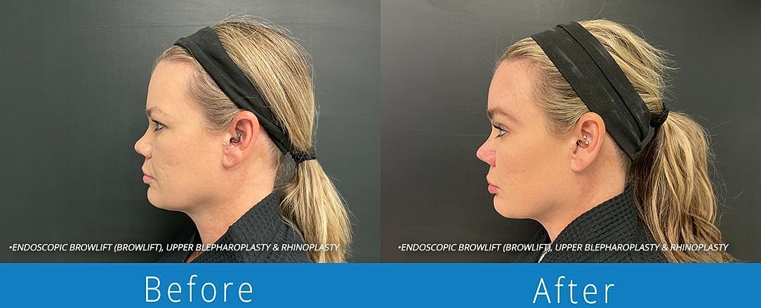 Brow Lift Before & After