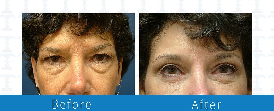 Brow Lift Before & After