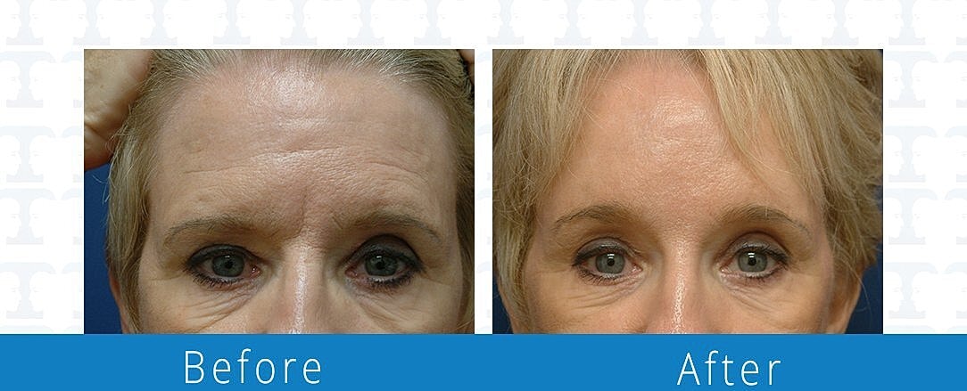 Brow Lift Before & After