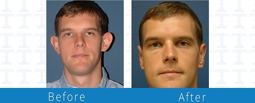 Otoplasty Before & After