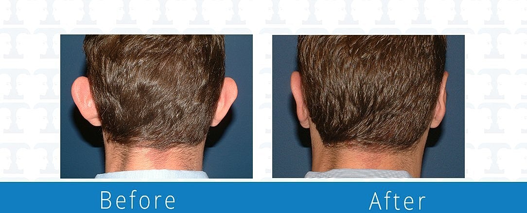 Otoplasty Before & After