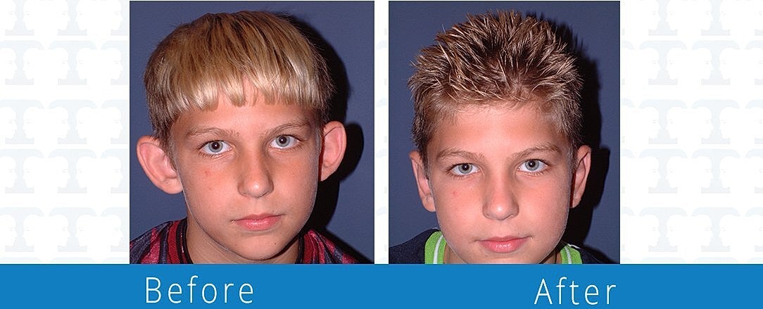 Otoplasty Before & After
