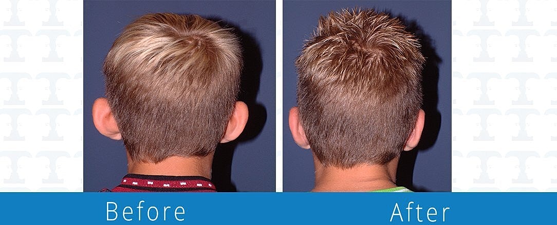 Otoplasty Before & After