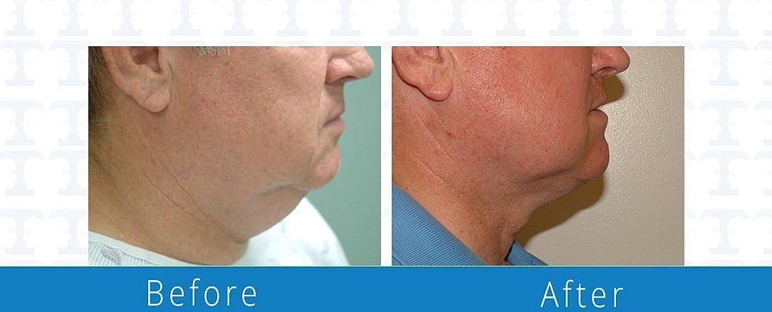 Facial Liposuction Before & After