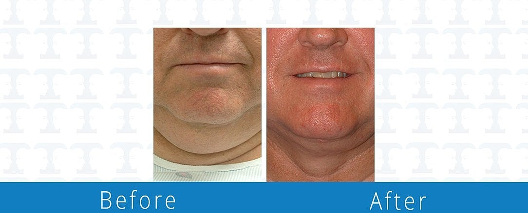 Facial Liposuction Before & After