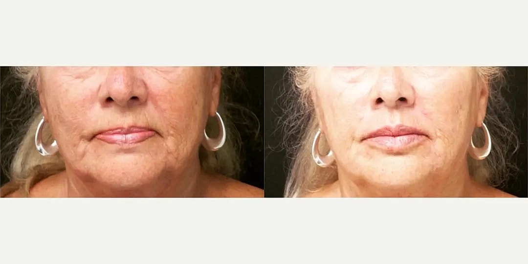 Juvéderm Before & After