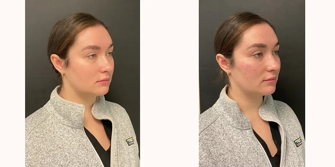 Juvéderm Before & After
