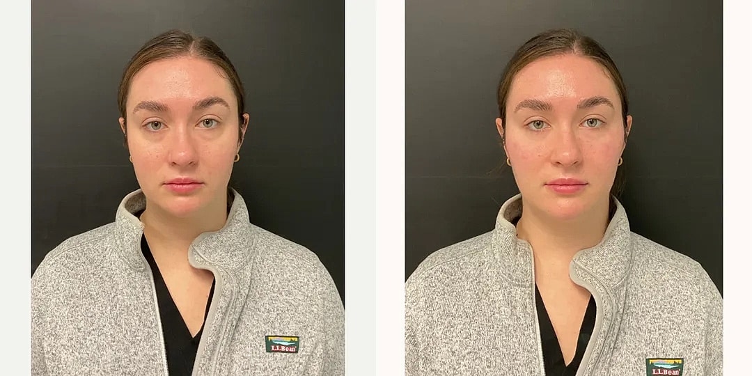 Juvéderm Before & After