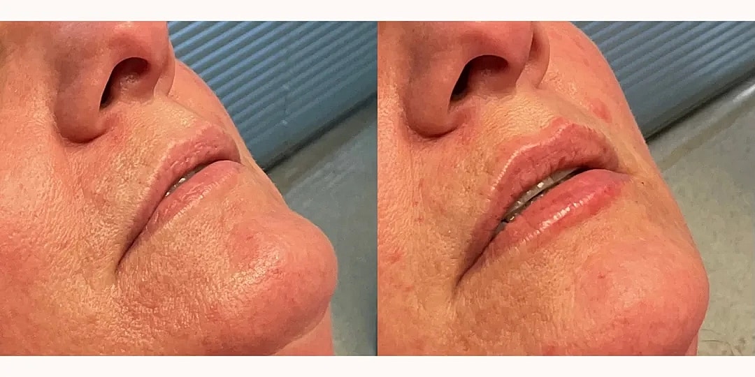 Juvéderm Before & After