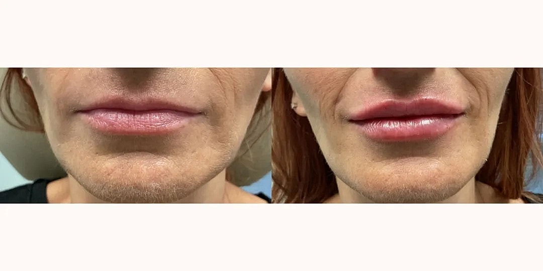 Juvéderm Before & After