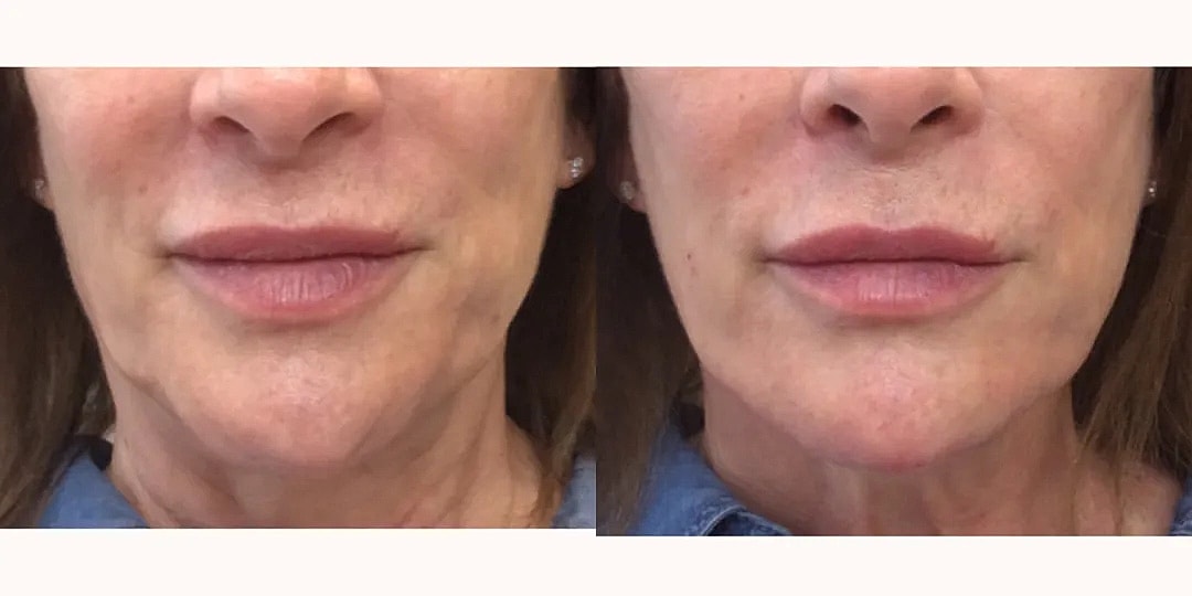 Juvéderm Before & After
