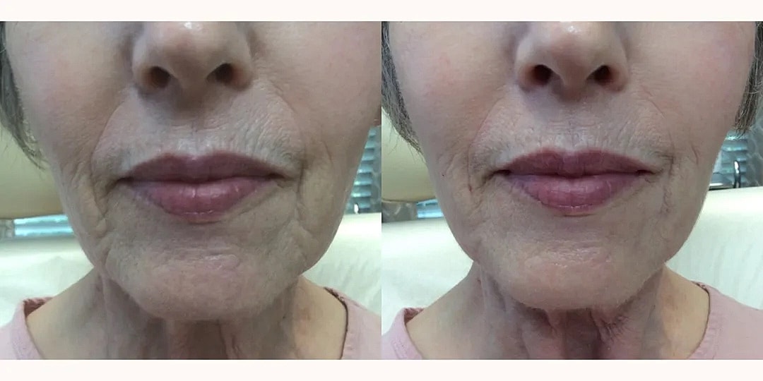 Juvéderm Before & After