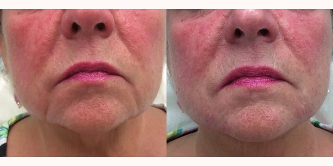 Juvéderm Before & After