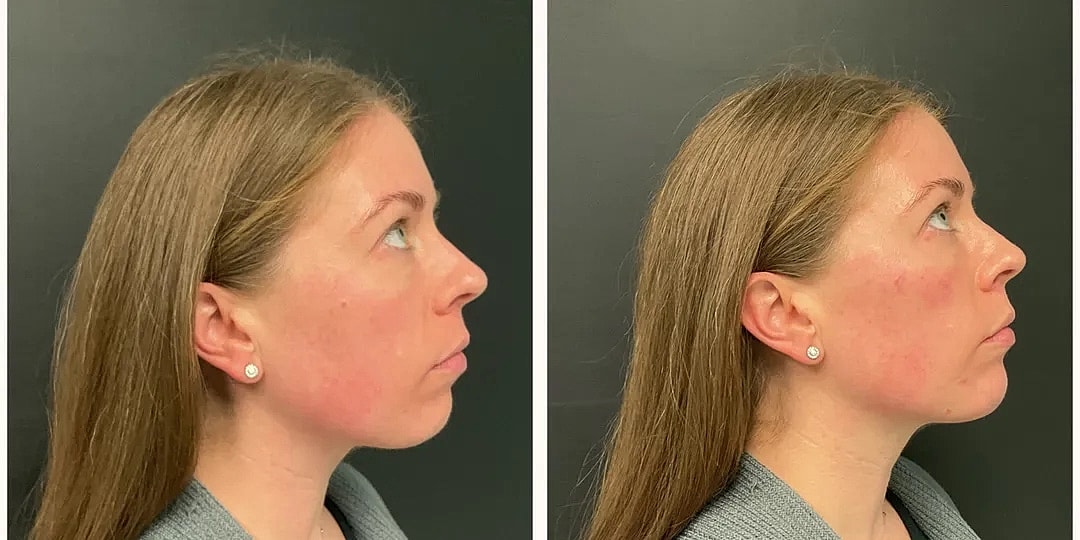 Juvéderm Before & After