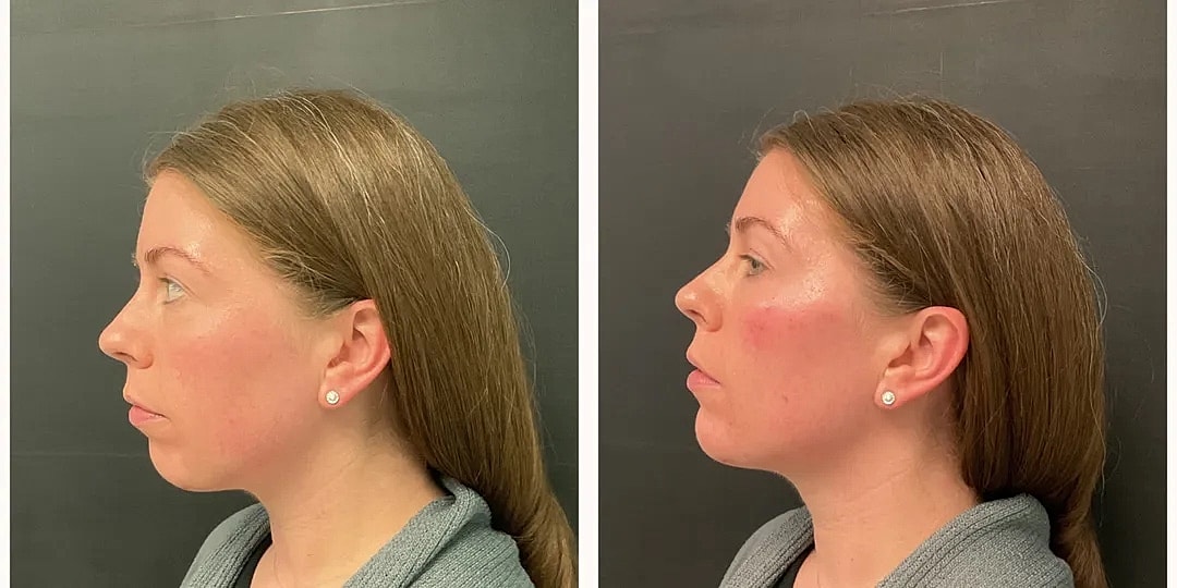 Juvéderm Before & After