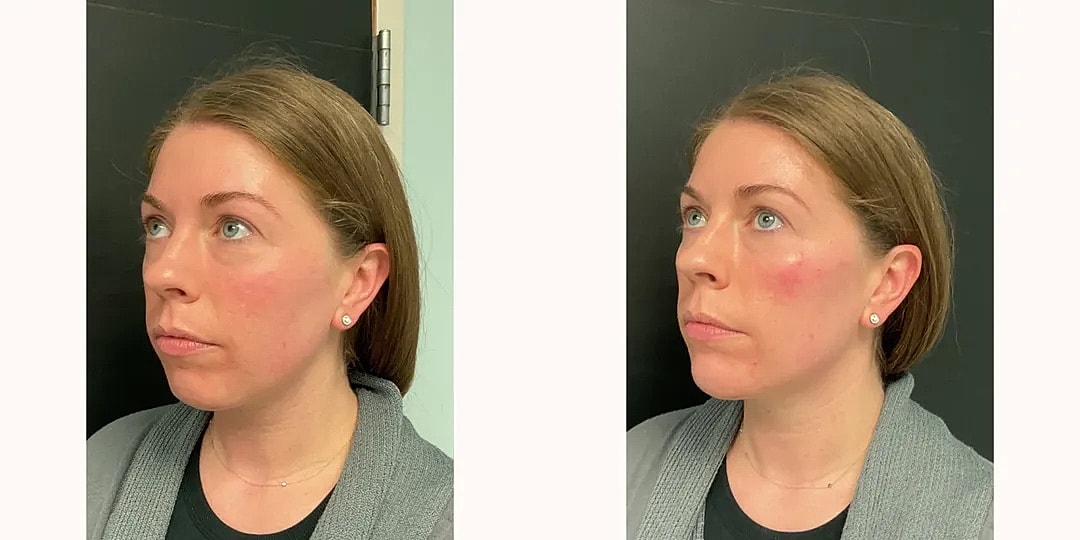 Juvéderm Before & After