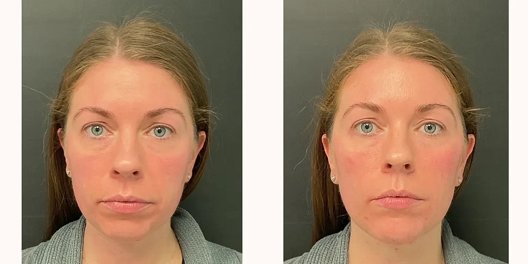 Juvéderm Before & After