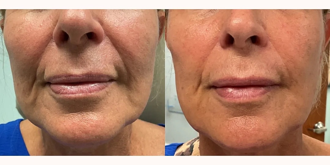 Juvéderm Before & After