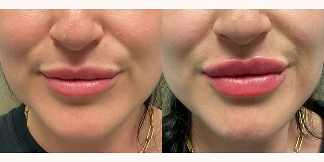 Juvéderm Before & After