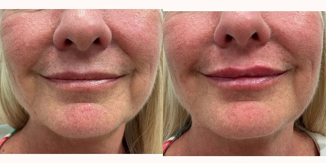 Juvéderm Before & After