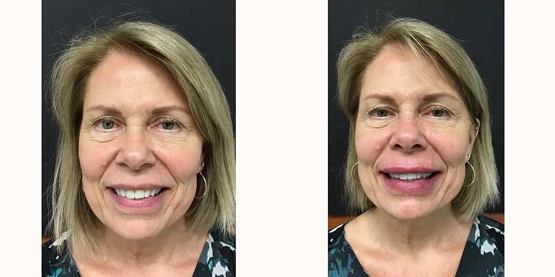 Juvéderm Before & After