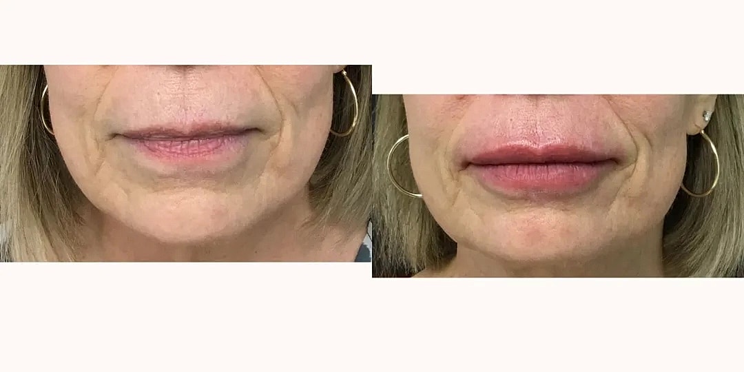 Juvéderm Before & After