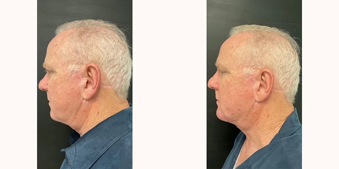 Juvéderm Before & After