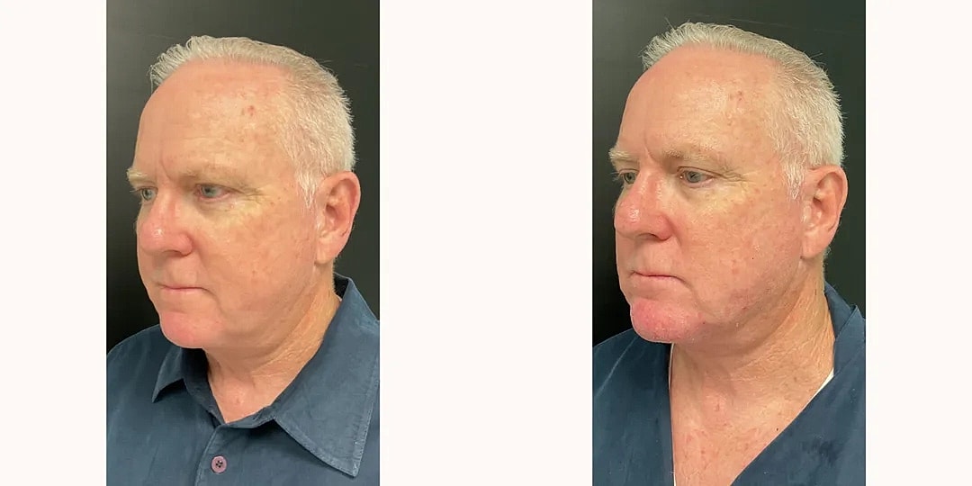 Juvéderm Before & After
