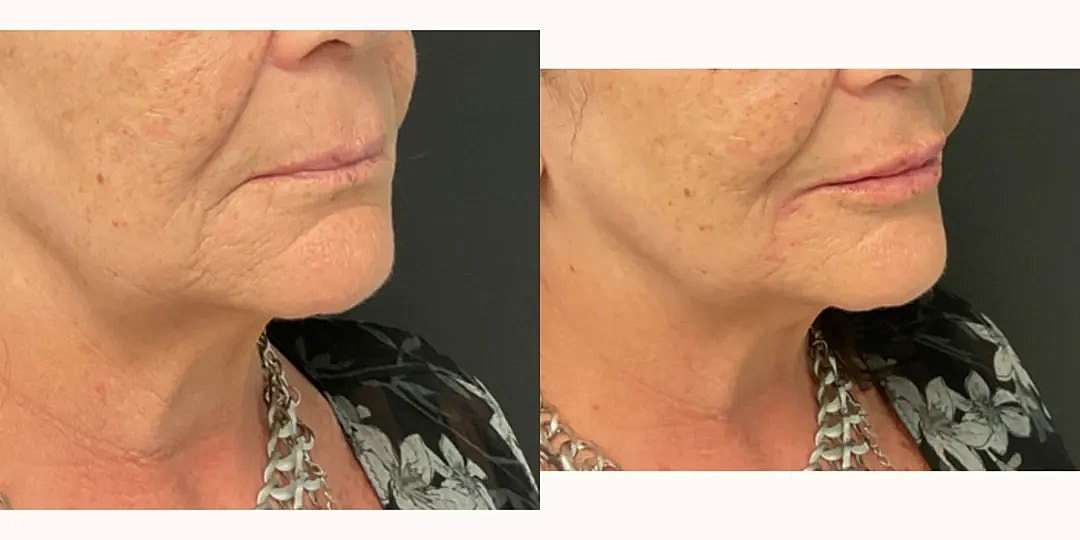 Juvéderm Before & After