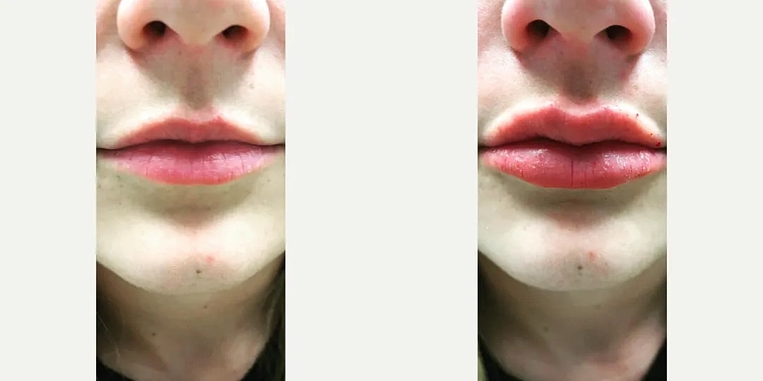 Juvéderm Before & After