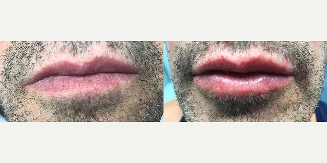 Juvéderm Before & After