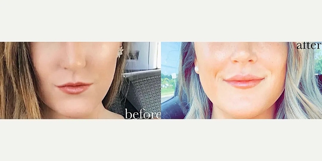 Juvéderm Before & After