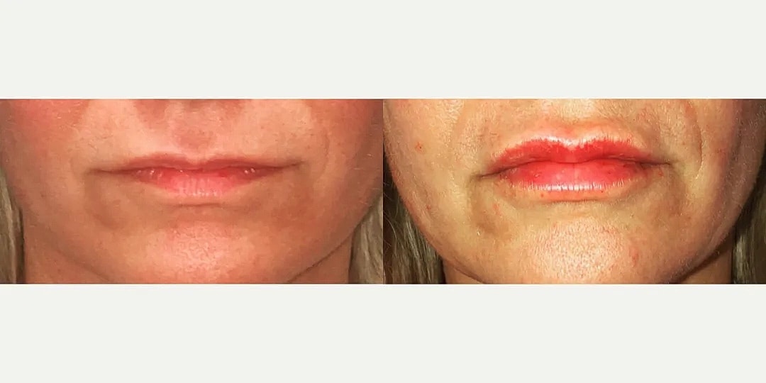 Juvéderm Before & After