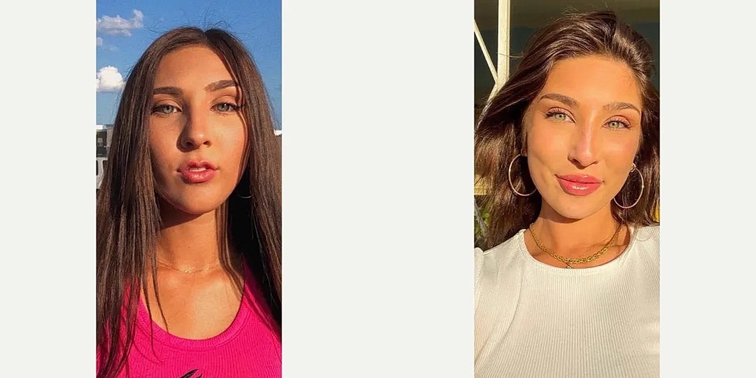 Juvéderm Before & After