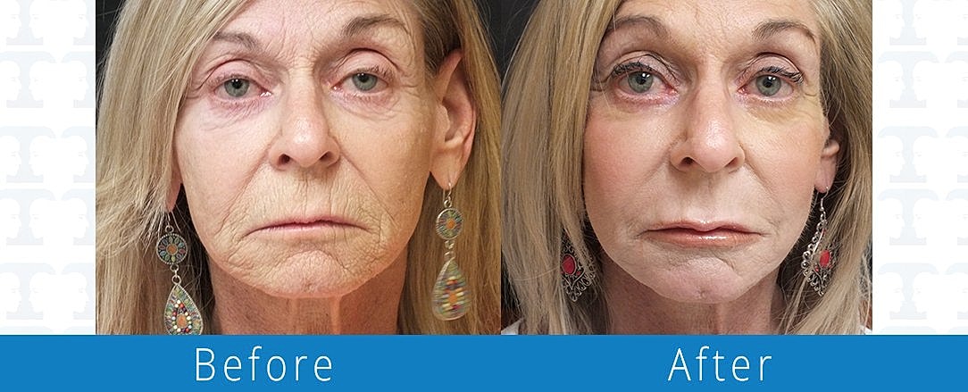 Juvéderm Before & After