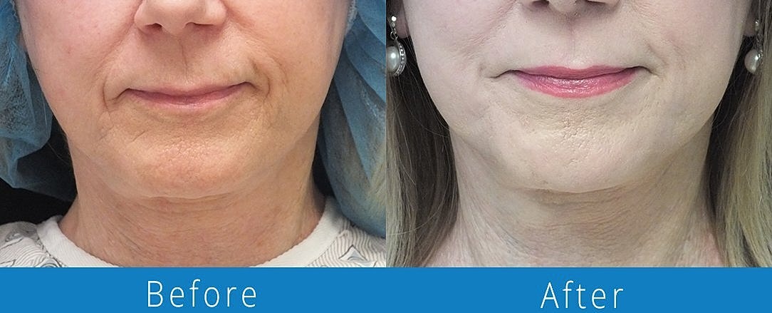 Co2 Laser Before & After