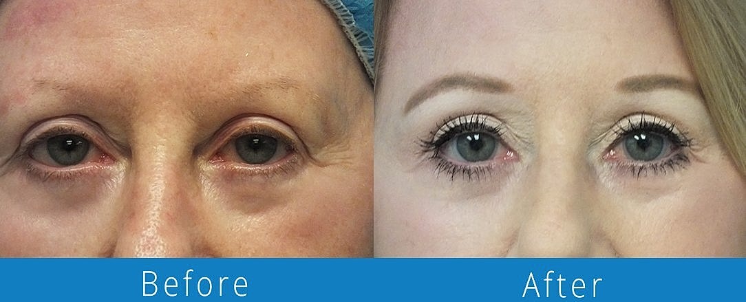 Co2 Laser Before & After