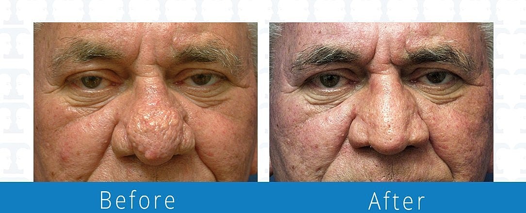 Rhinophyma Before & After