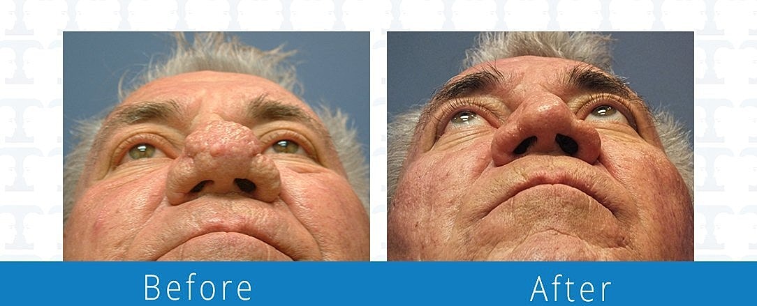 Rhinophyma Before & After