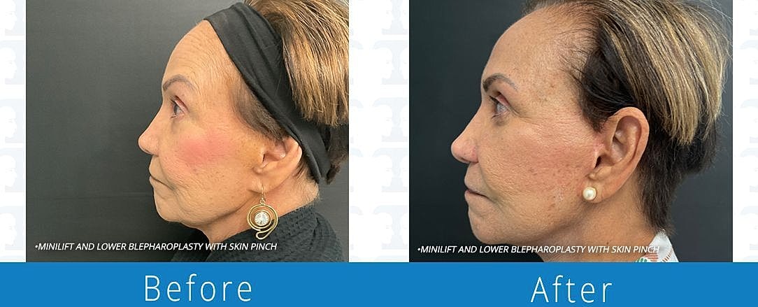 Facelift Before & After