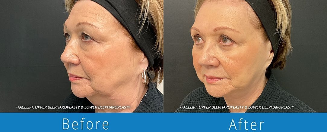 Facelift Before & After