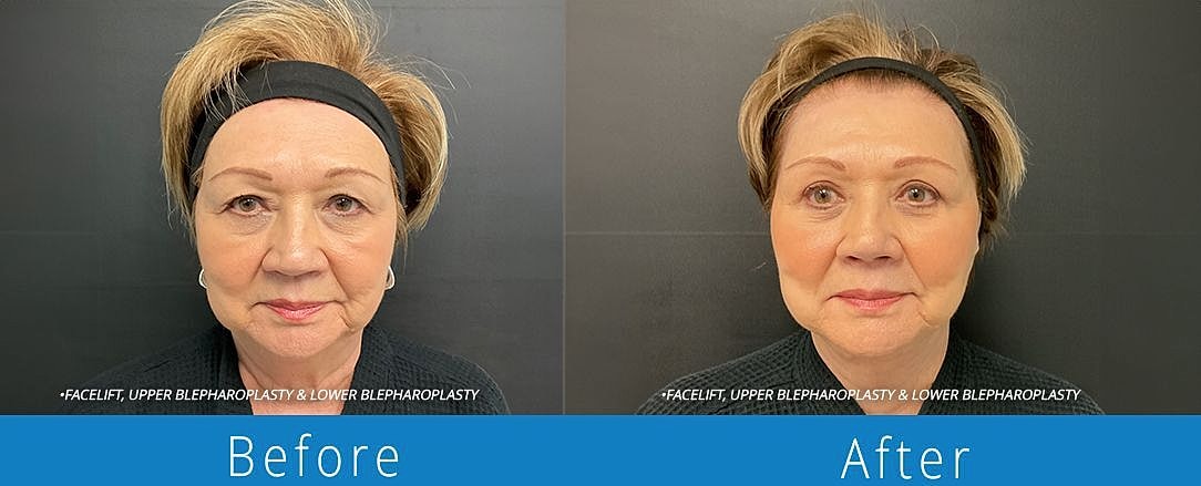 Facelift Before & After