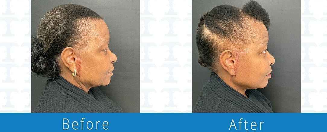 Facelift Before & After
