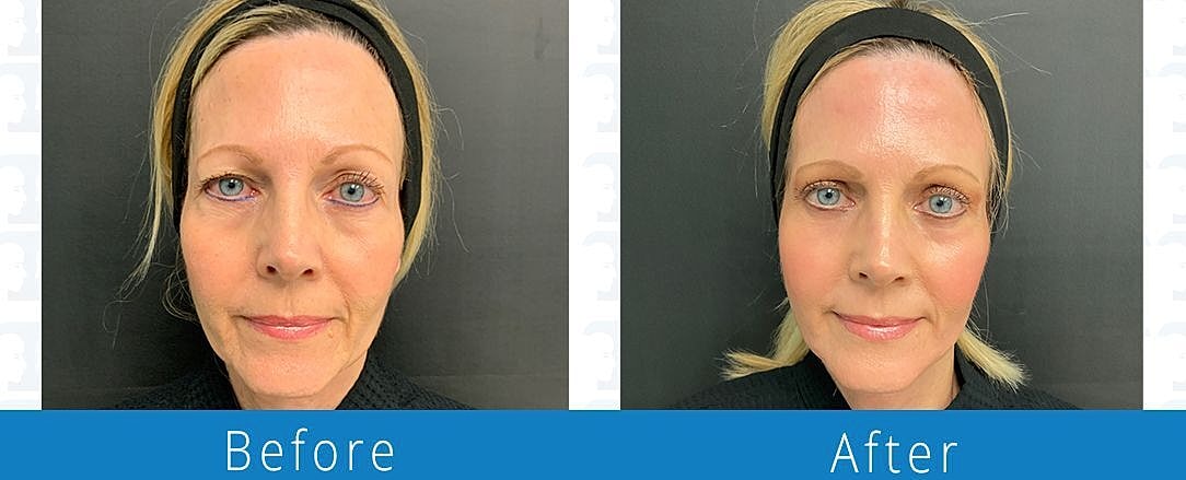 Facelift Before & After