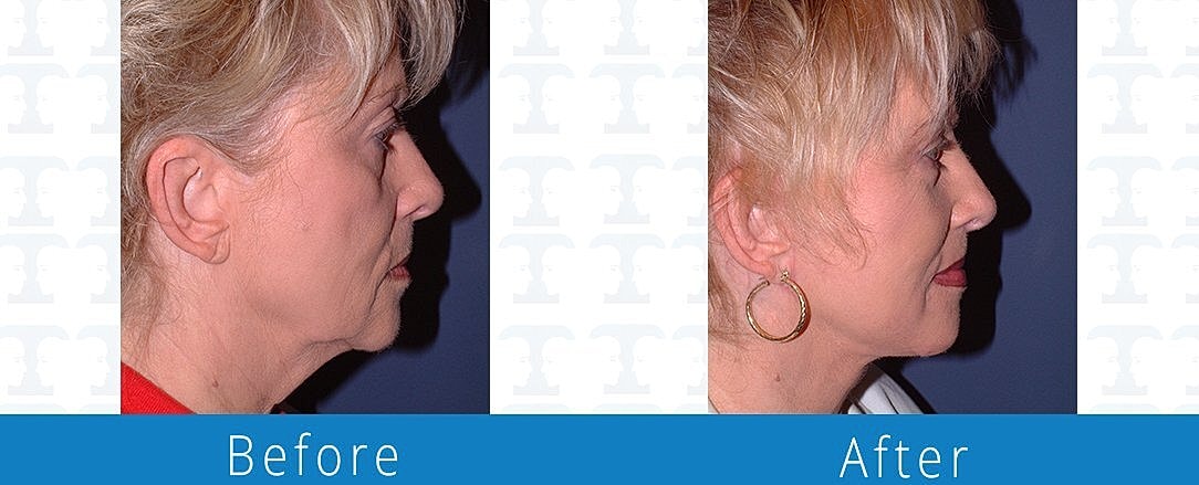 Facelift Before & After
