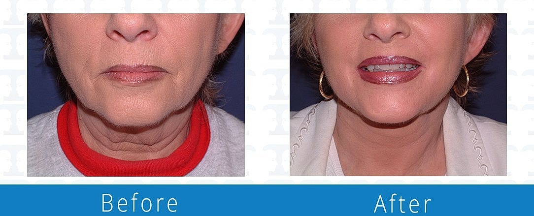 Facelift Before & After