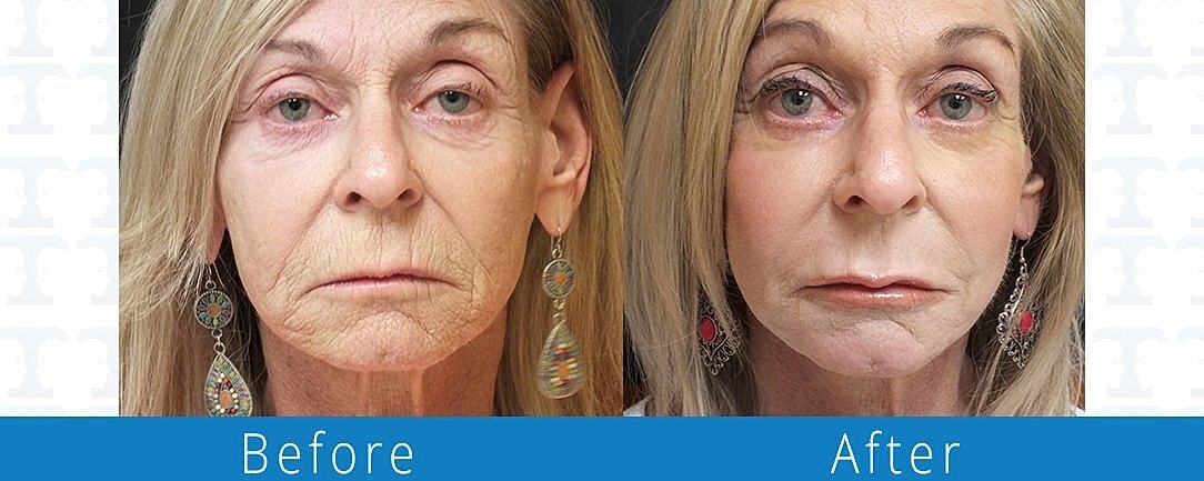 Facelift Before & After